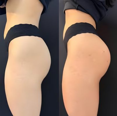 Bumbum Up - Preenchimento com Ácido Hialurônico - Bioestímulo de Colágeno