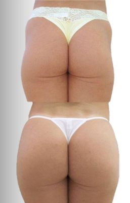 Preenchimento Glúteo/Hip dips - Melhora do contorno corporal