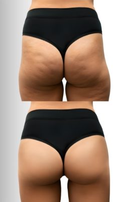 Estímulo de Colágeno - Melhora da celulite e flacidez